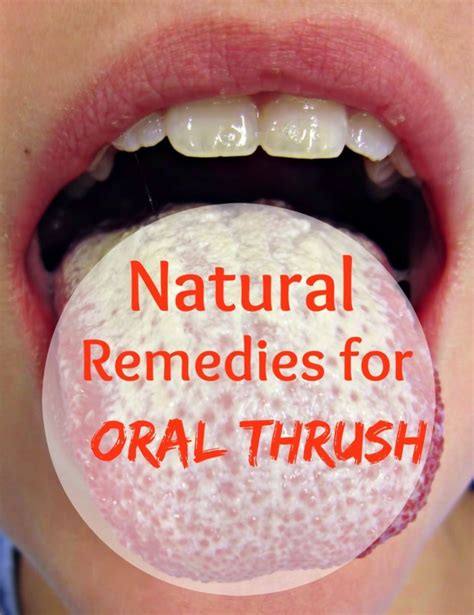 Natural Remedies for Oral Thrush | HealthMix Info