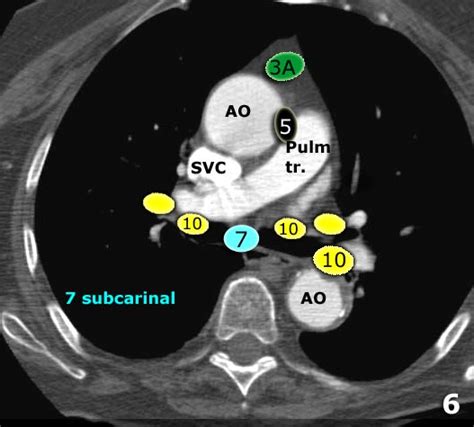 The Radiology Assistant Mediastinum Lymph Node Map | Images and Photos ...