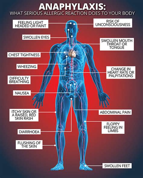 Anaphylaxis: Do YOU know the symptoms of a severe allergic reaction ...