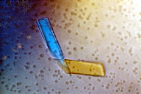 Pathology Of Multiple Myeloma Pathology Made Simple | Hot Sex Picture