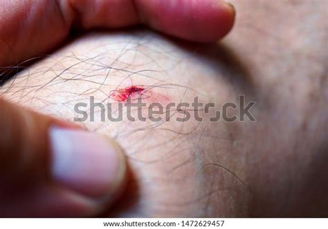 Bloody Wounds Skin Wound Blood Flow Stock Photo 1472629457 | Shutterstock