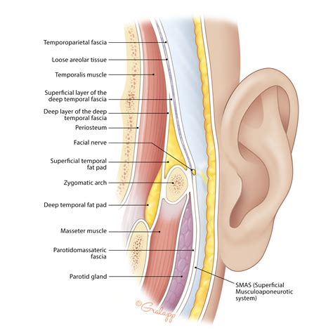 Preauricular Cyst Excision – Oto Surgery Atlas