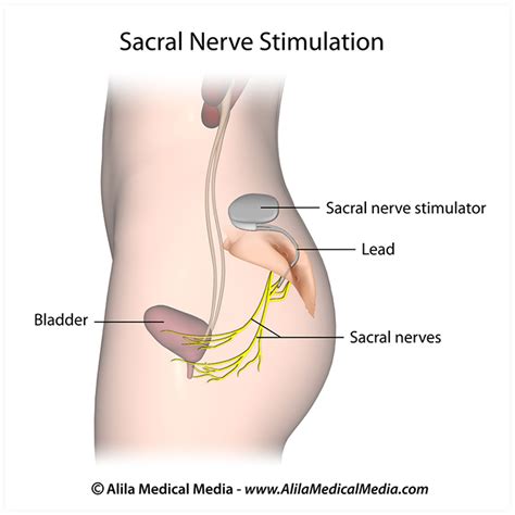 Overactive Bladder Interstim NYC - Women’s Urology New York