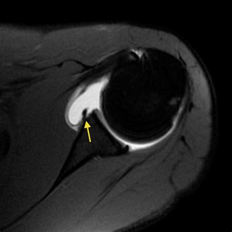 Glenoid labral tear - Radiology at St. Vincent's University Hospital