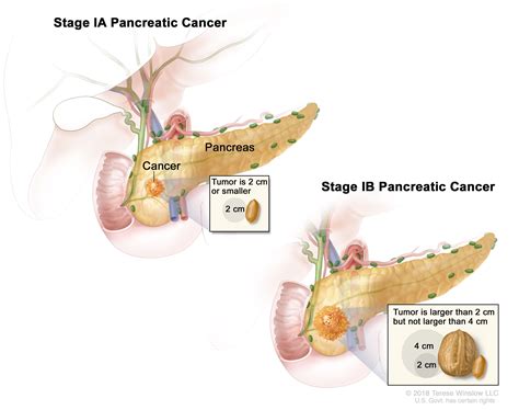 Pancreatic Cancer | UCSF Department of Surgery