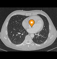 Noncoronary aortic sinus - e-Anatomy - IMAIOS