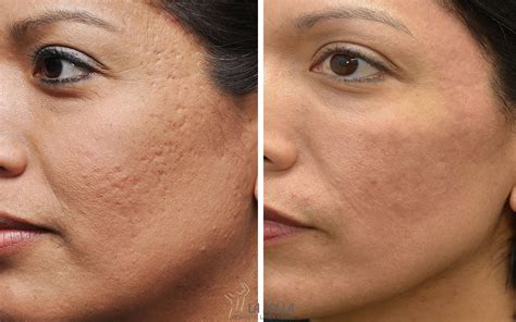 acne scar Archives - Comprehensive Dermatology Center of Pasadena