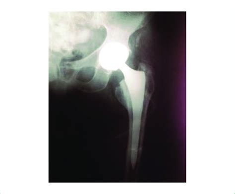 Left Total Hip Arthroplasty 5 years post operatively. | Download ...