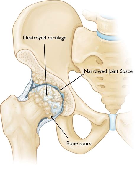 Orion - Hip Arthritis