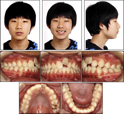 Orthodontic treatment of an ankylosed maxillary central incisor through ...