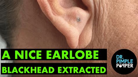 A Nice Earlobe Blackhead - Blackheads & Whiteheads Galore - Dr. Pimple ...