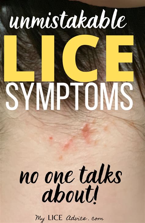 17 Lice Symptoms with Pictures: Signs That You Have Head Lice - My Lice ...