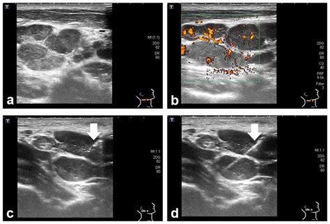 Swollen Lymph Nodes In Neck Ultrasound