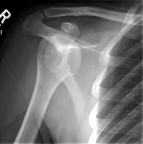 Ortho Dx: A corrections officer with a dislocated shoulder - Clinical ...