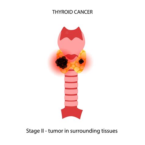 Premium Vector | Thyroid cancer stages