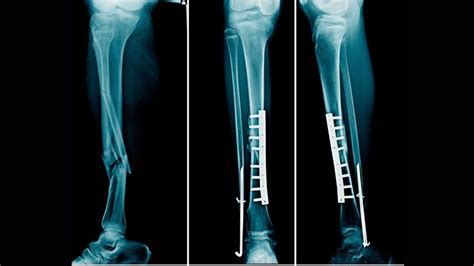 Tibia Fibula Fracture Rehab Protocol, physiotherapy Exercises