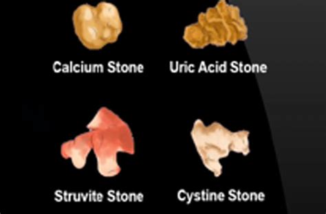 Uric Acid Kidney Stones