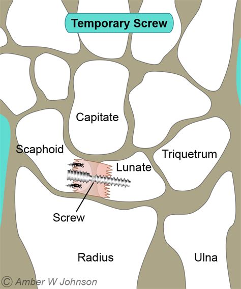 Sl Ligament Surgery Pictures to Pin on Pinterest - ThePinsta