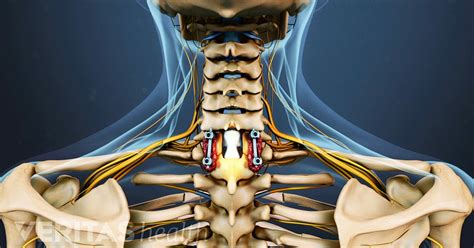 Cervical Spine Surgery