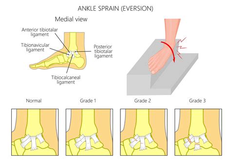 Causes of Inner Ankle Pain Explained by a Foot Specialist