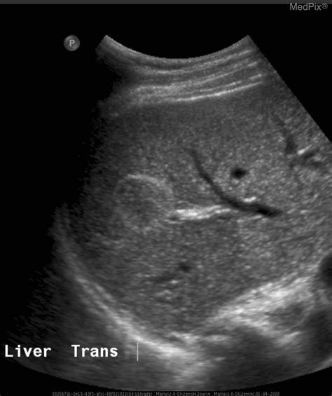 Hepatic Hemangioma Ultrasound