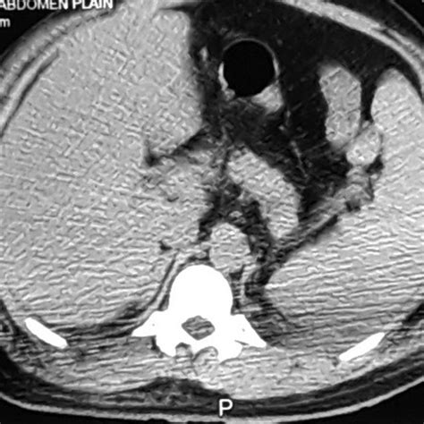 Computed tomography of the head revealed calcified granuloma in the ...