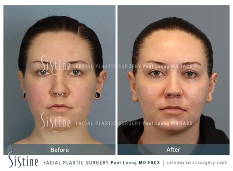 Buccal Fat Removal Before and After | Sistine Facial Plastic Surgery