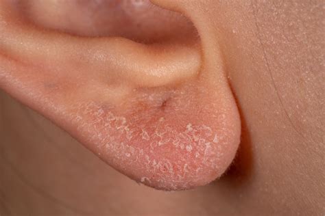 What Causes Dry Ears? - Open Web Portal