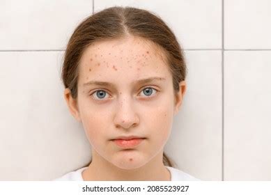 Face Teenage Girl Pimples Acne On Stock Photo 2085523927 | Shutterstock