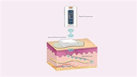 New Devices That Can Help You Manage Overactive Bladder