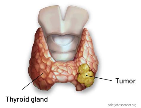 Thyroid Cancer Symptoms, Diagnosis, Surgery, Treatment, and Prognosis ...