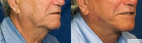 Laser Facelift – Murrieta Facial Plastic Surgery