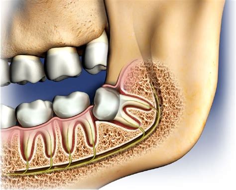 Are your wisdom teeth causing you pain and discomfort? Wisdom teeth ...