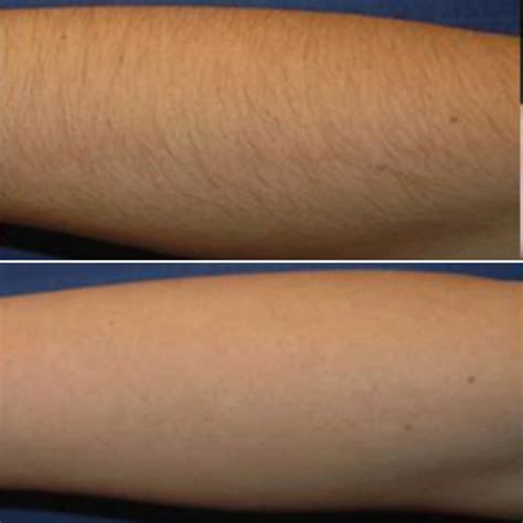 Forearms Laser Hair Removal | 3D LifeStyle