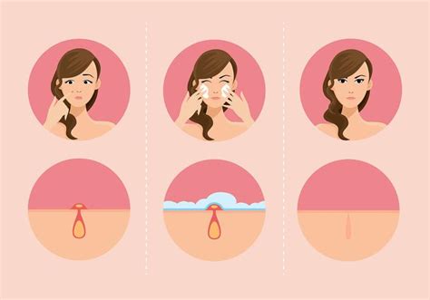 Girls And Pimples Free Vector 161171 Vector Art at Vecteezy