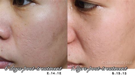 Fractional CO2 Laser for Acne Scars - Results, Photos, and the Rough ...