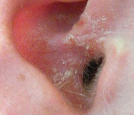 Dry Skin in Ears, Inside Ear Canal, Itchy, Flaky Skin Behind Ears ...