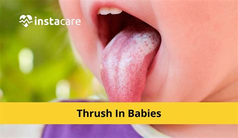 Oral Thrush In Babies - Symptoms, Causes, And Treatments