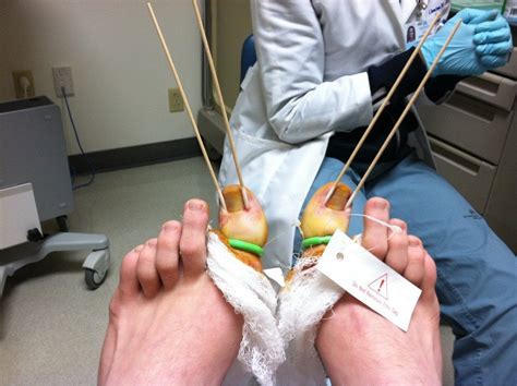 Ingrown toenail surgery. : r/WTF