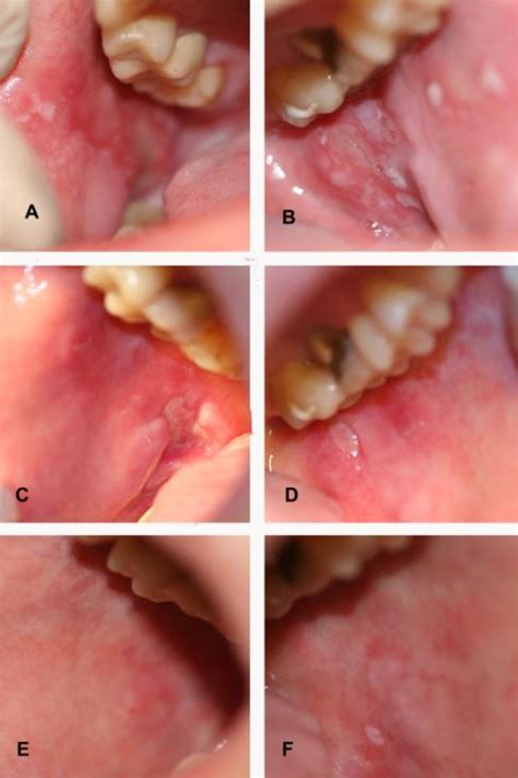 (A and B) Buccal mucosa (right and left, respectively) of an oncologic ...