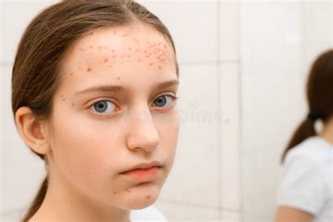 308 Pimples Teenage Girl Stock Photos - Free & Royalty-Free Stock ...