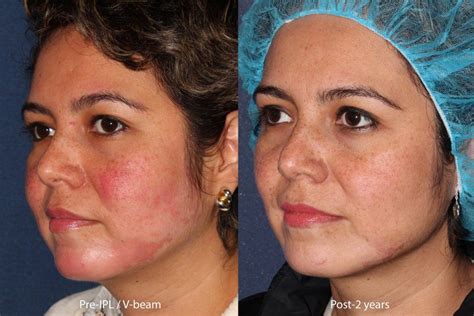 Rosacea Redness Treatment MedSpa | San Diego, CA | CLDerm