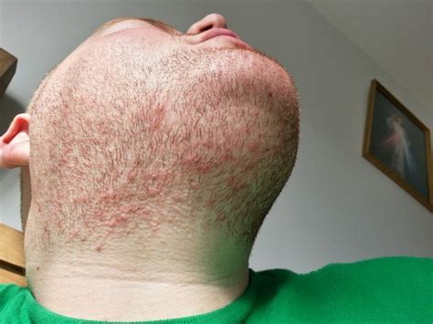 rash under beard - pictures, photos