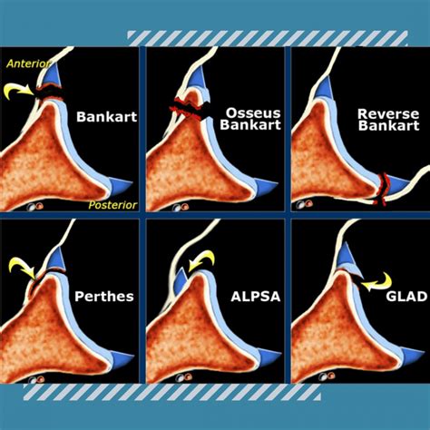 Types of Labral Tears | Ashvin K Dewan, MD