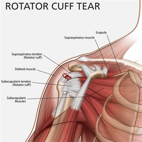 Rotator Cuff Injury: Physical Therapy and Surgery