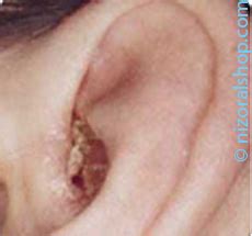 Ear Psoriasis