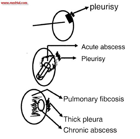 Lung abscess definition, causes, pathology and treatment