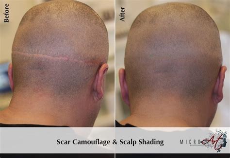 Scar Treatment By MicroArt Semi Permanent Scar Camouflage