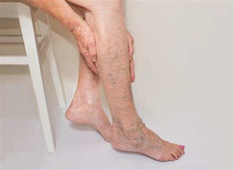 How To Avoid Getting Varicose Veins - Memberfeeling16