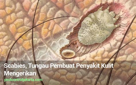 Scabies, Tungau Pembuat Penyakit Kulit Mengerikan | FUMIDA